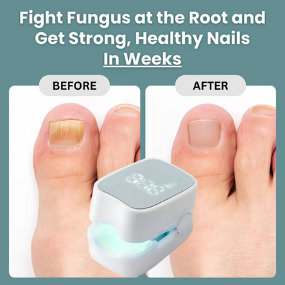 Allivora™ - Nail Fungus Laser Device