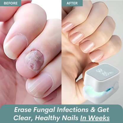 Allivora™ - Nail Fungus Laser Device