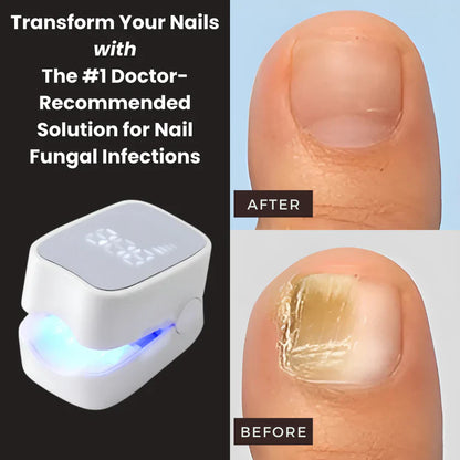 Allivora™ - Nail Fungus Laser Device